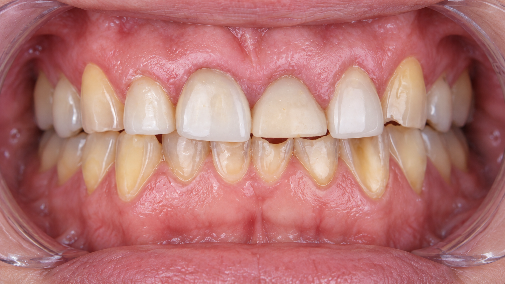Digitally reconstructed illustration: Before treatment, E-Max crowns