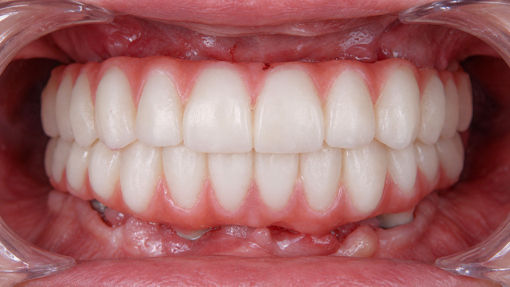 Digitally reconstructed illustration: Later treatment stage, Full-arch implant restoration
