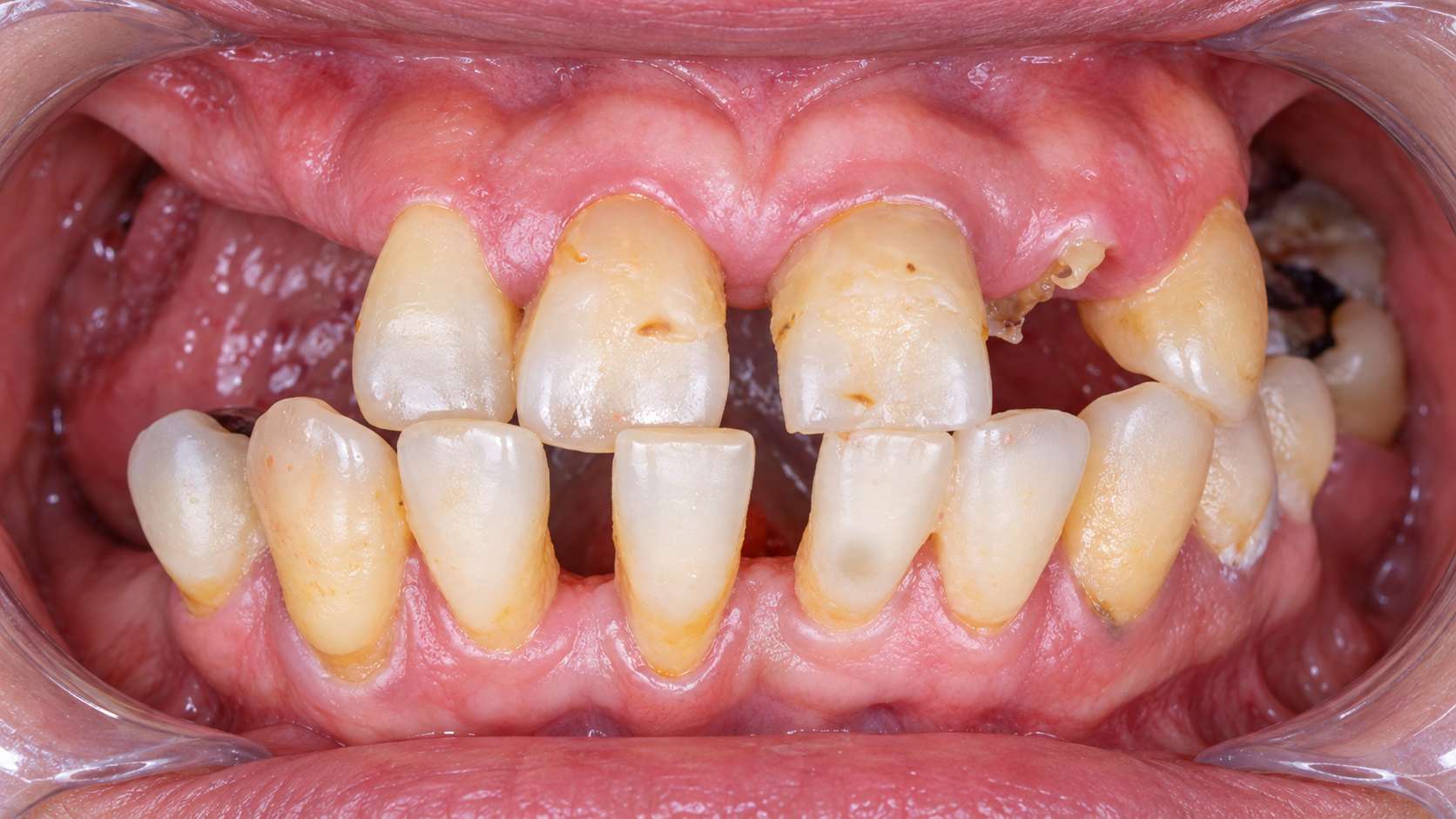 Digitally reconstructed illustration: Before treatment, Full-arch implant restoration