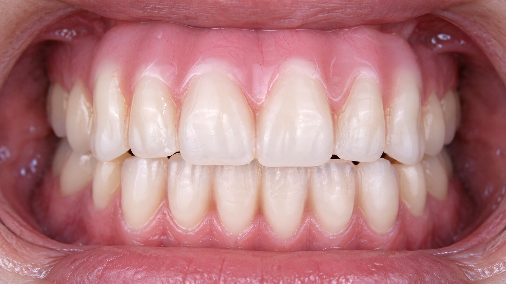 Digitally reconstructed illustration: Temporary stage, Fixed temporary teeth