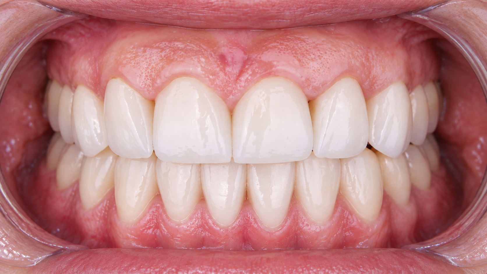 Digitally reconstructed illustration: Later treatment stage, Zirconia crowns