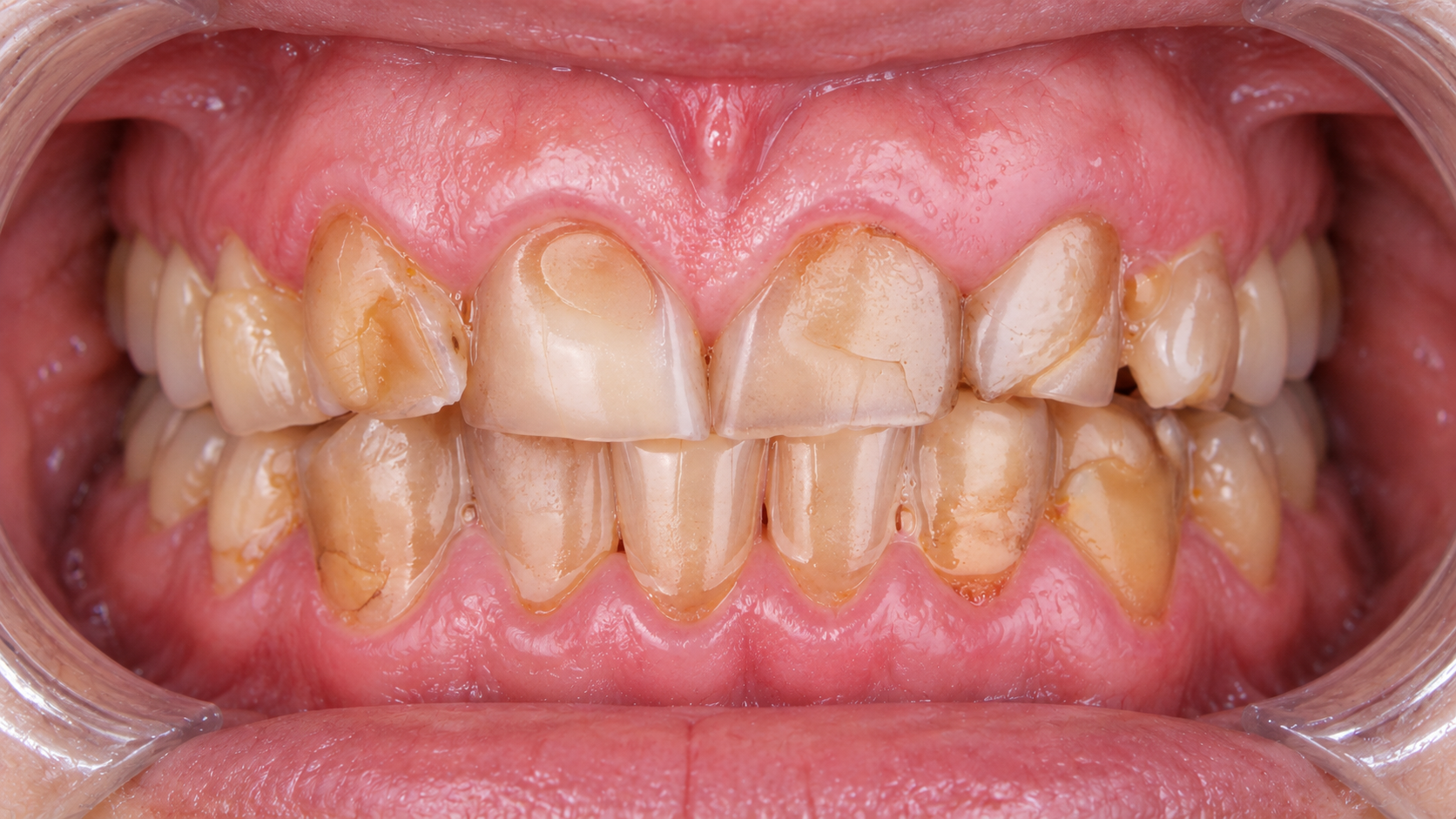 Digitally reconstructed illustration: Before treatment, Zirconia crowns